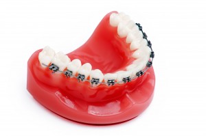 dental implant Temecula