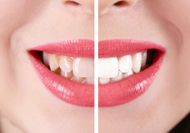 Reasons a Patient May Need Teeth Whitening in Beaumont, TX ...