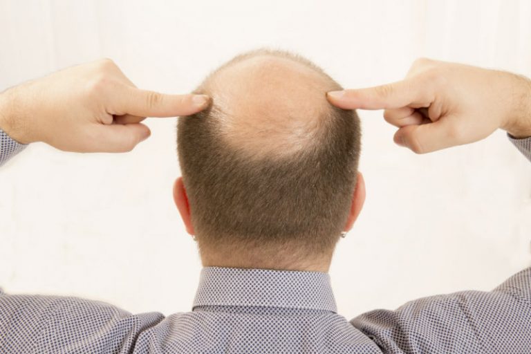 The Advantages of Undergoing a Hair Transplant in NJ