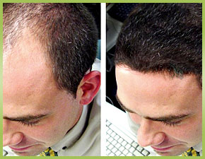 Are You a Good Candidate for Hair Restoration?