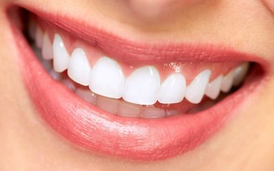 Pros and Cons of Teeth Whitening in New Lenox